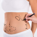 abdominal plastic surgery