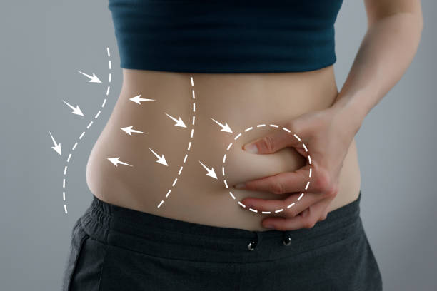 liposculpting surgery - body contouring