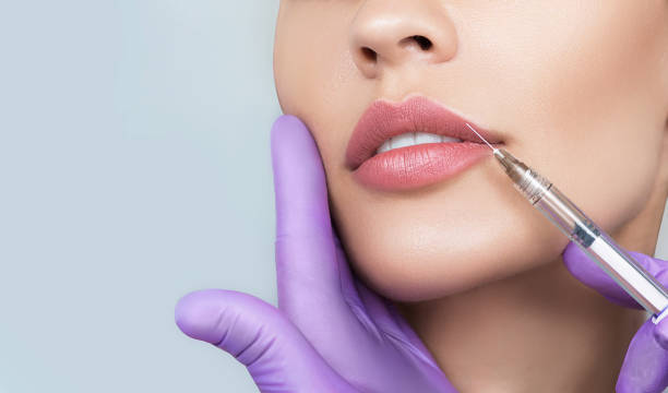 lip enhancement fillers in bangalore