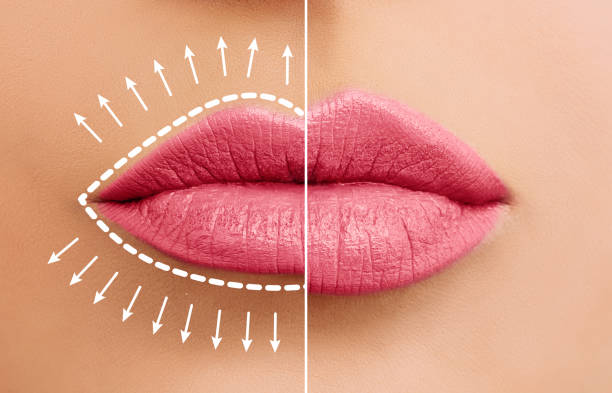 lip enhancement fillers in bangalore