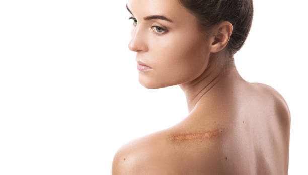 scar revision surgery