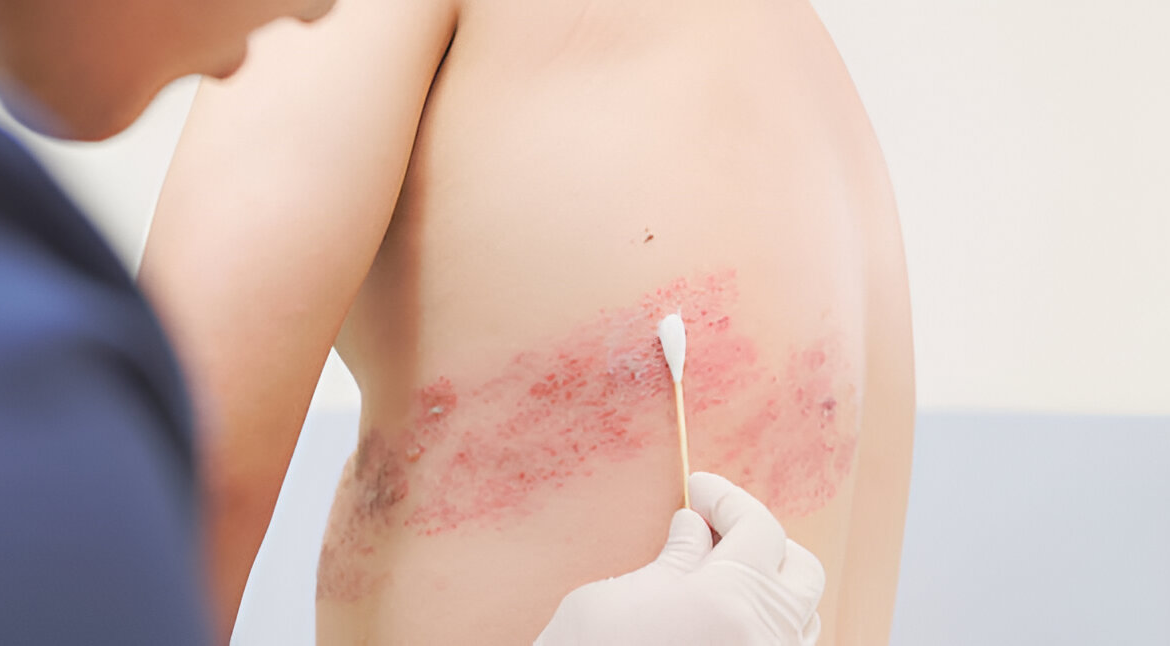 Best Hospital for Burns Treatment in Bangalore