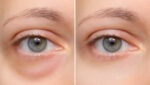 Top Under-eye Filler Treatments in Bangalore