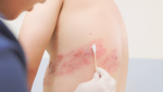 Best Hospital for Burns Treatment in Bangalore