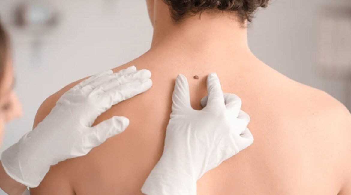 Safe & Effective Mole Removal Treatments in Bangalore