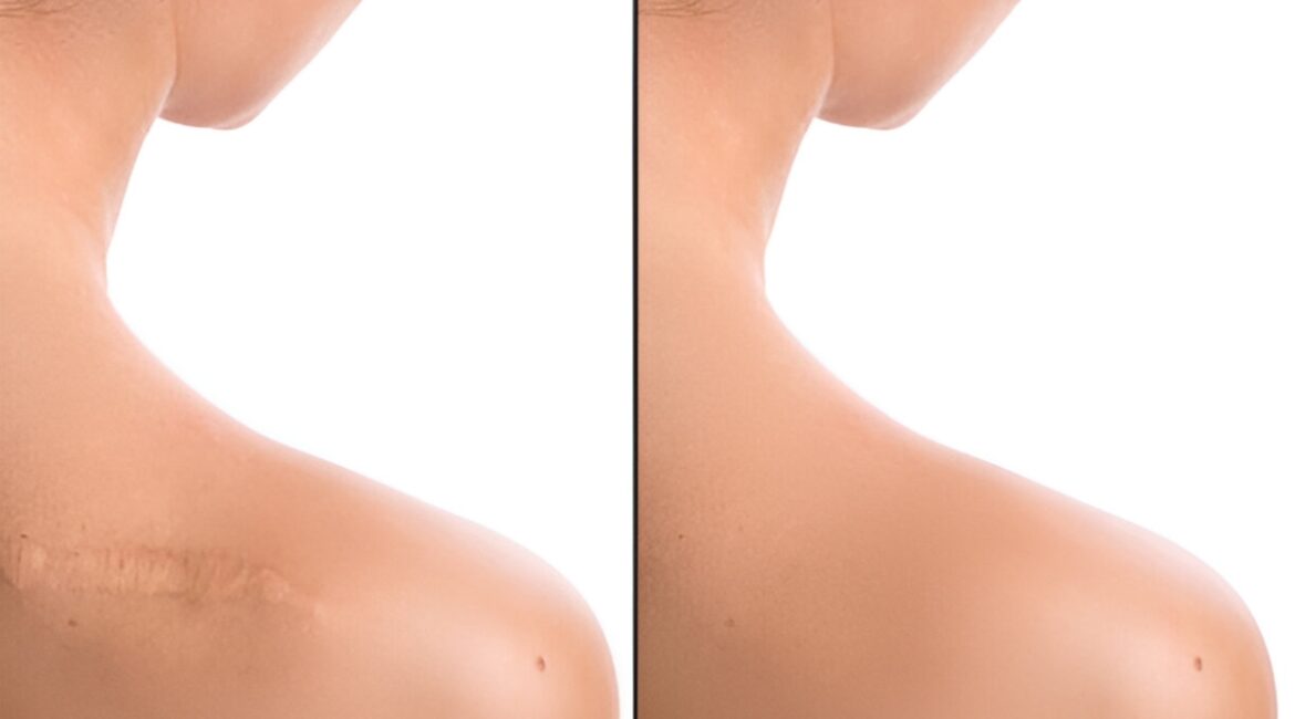 Scar Revision Surgery in Bangalore