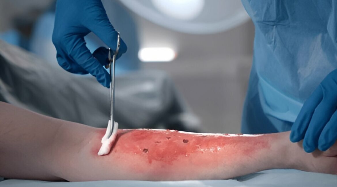 Advanced Skin Burn Care & Treatment in Bangalore