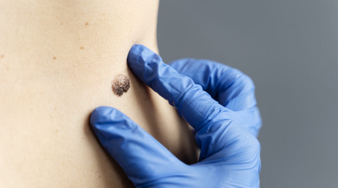 Advanced Skin Cancer Diagnostic Solutions in Bangalore