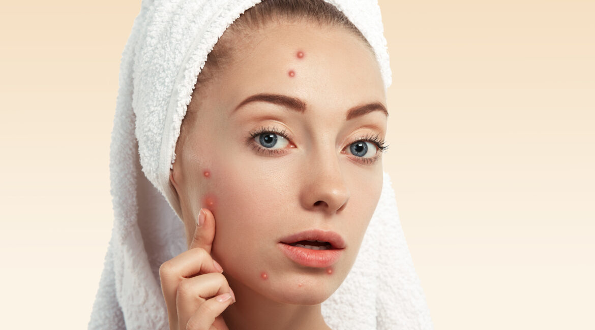 Effective Acne Scar Removal in Bangalore