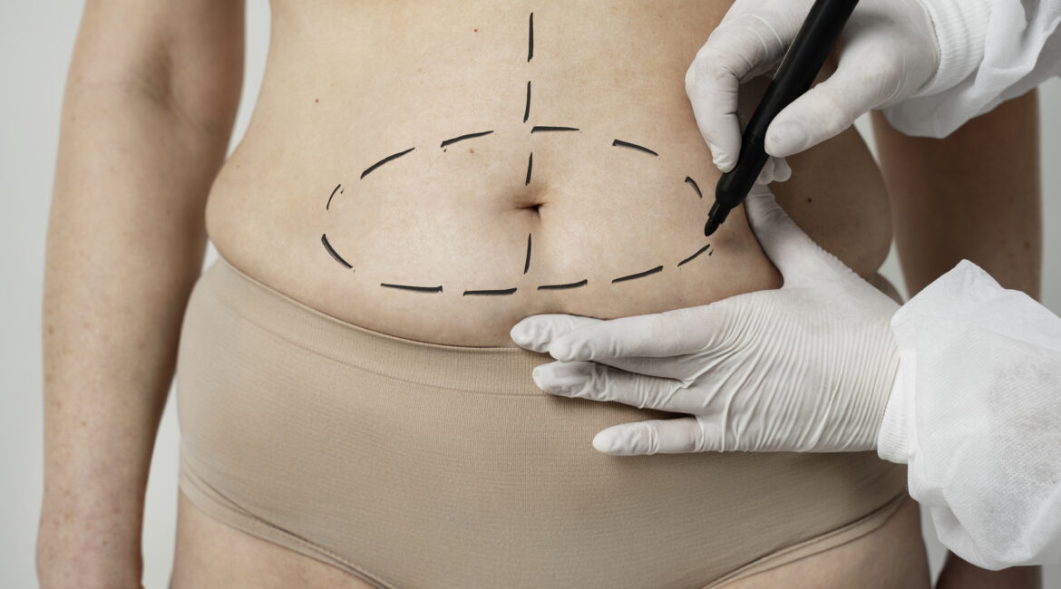 Tummy Tuck Surgery in Bangalore