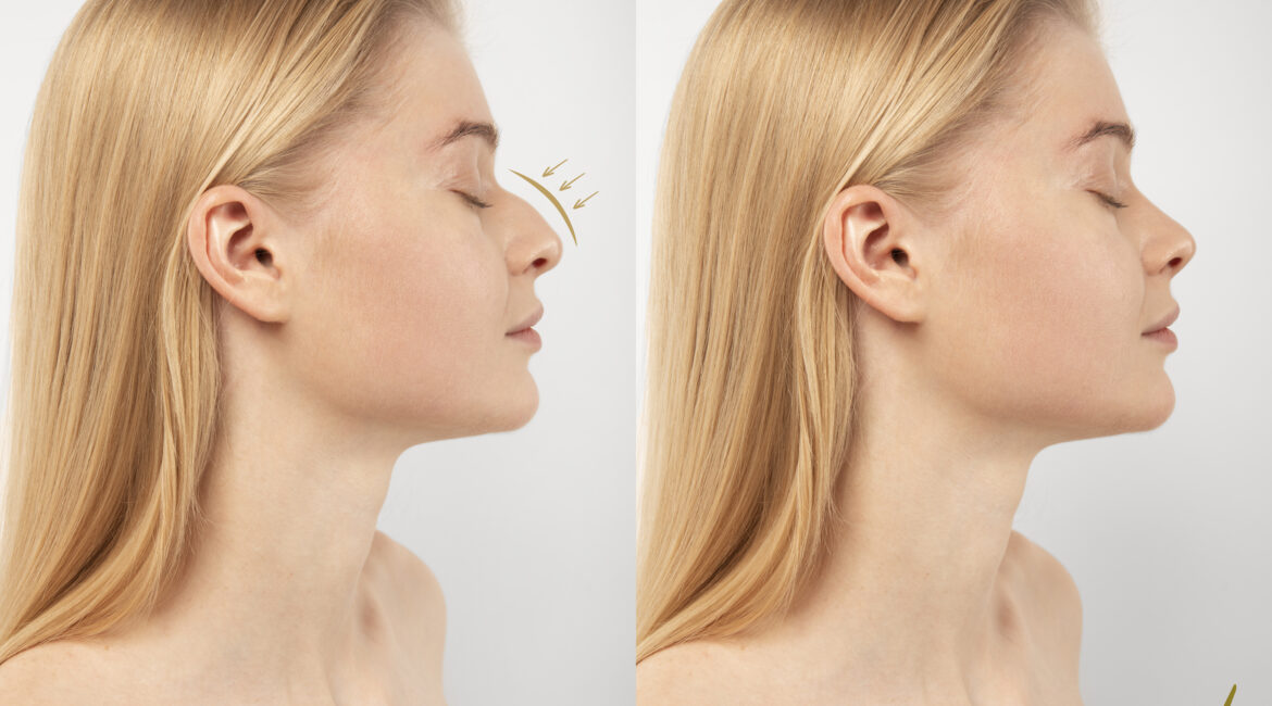 Rhinoplasty in Bangalore