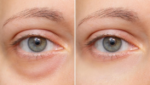 Best Under Eye Fillers in Bangalore – Restore Youthful Eyes with Expert Precision