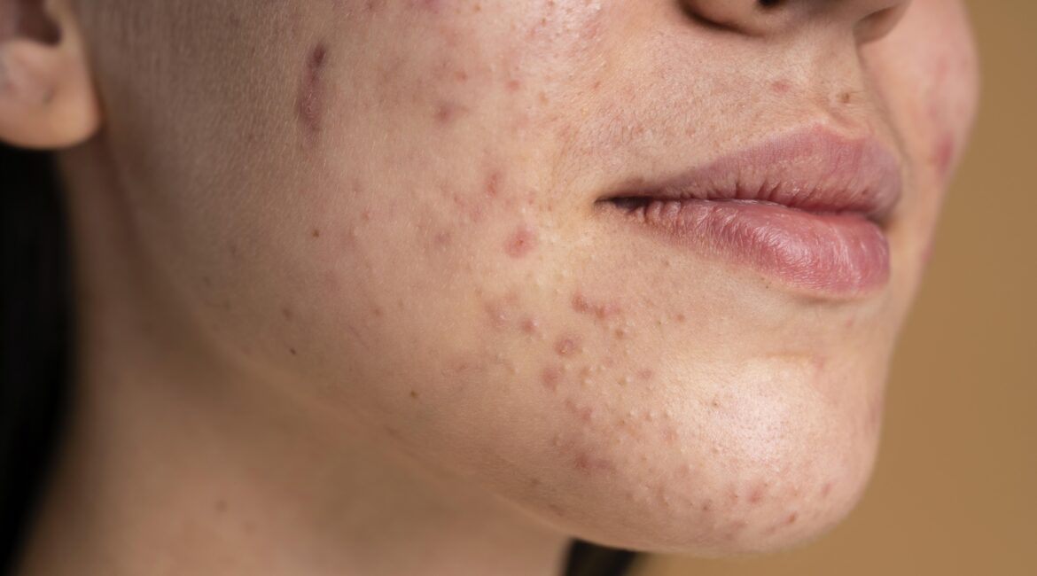best acne scar treatment cost in bangalore