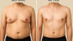 Gynecomastia Surgery in Bangalore