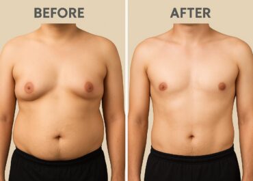 Gynecomastia Surgery in Bangalore | Natural Chest Contouring for Men at Phoenix Plastic Surgery Centre