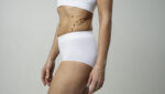 liposuction surgery in Bangalore