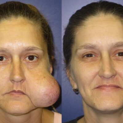 cancer-reconstruction